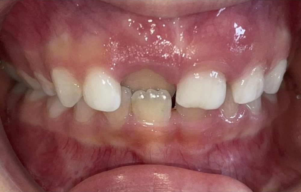 Dentes de uma criança antes do tratamento